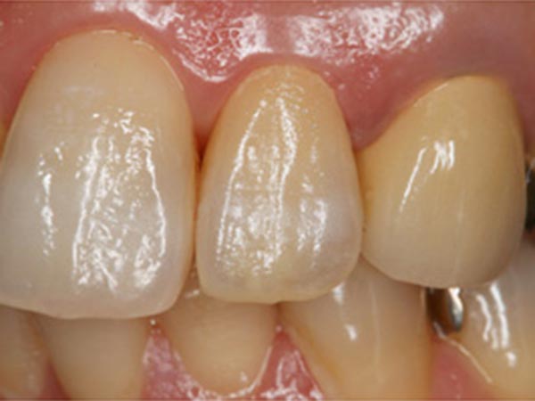 審美歯科症例「どの歯を治療したのかお分かりになるでしょうか?」
