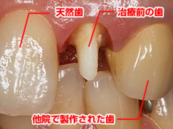 審美歯科症例「中央の歯が治療した歯です」