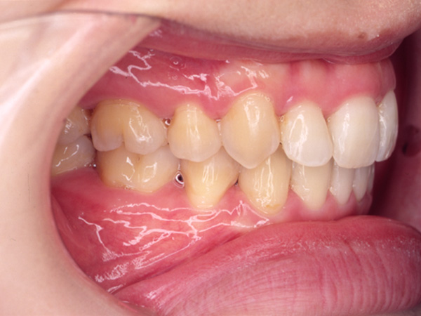 前歯のデコボコ 右側面の様子 After