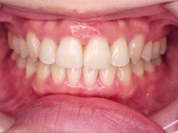 前歯のデコボコ 正面の様子 After