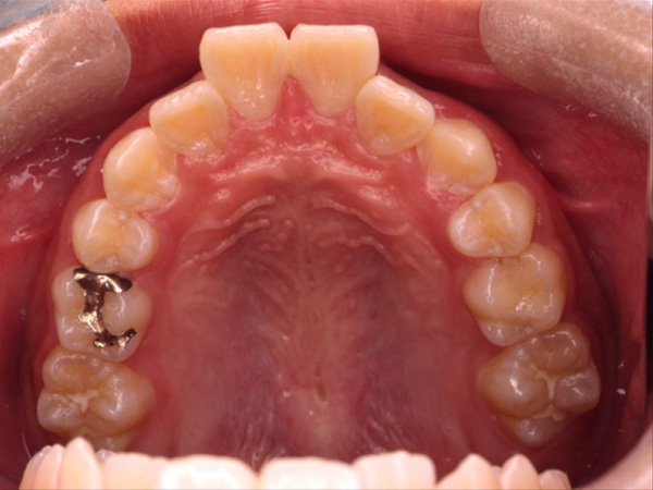 出っ歯 上顎の様子 Before