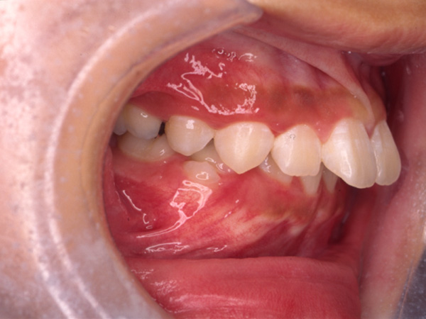 出っ歯 右側面の様子 Before