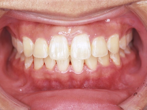 出っ歯  正面の様子 After