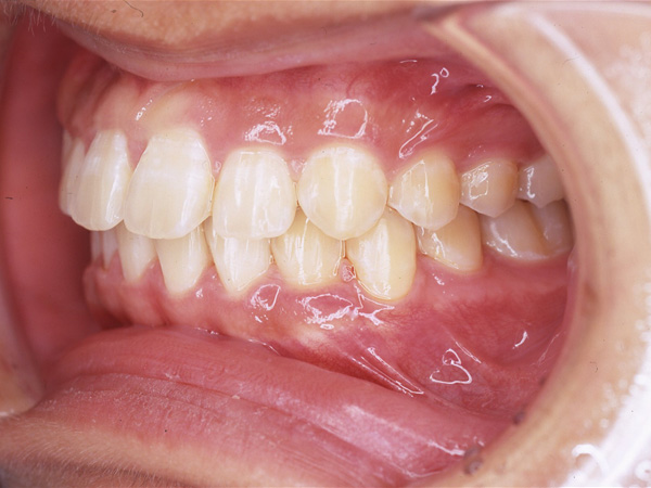 出っ歯 左側面の様子 After