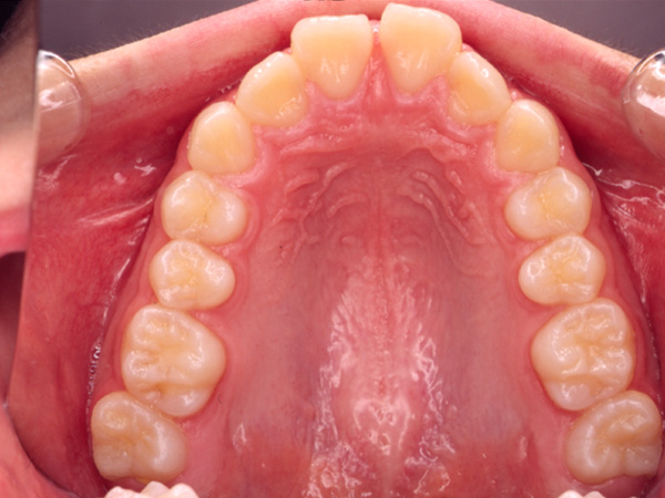 出っ歯 上顎の様子 Before