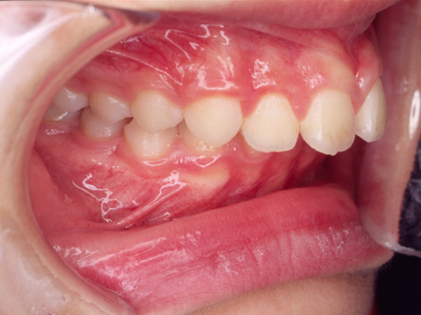 出っ歯 右側面の様子 Before