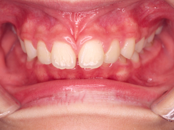 出っ歯 正面の様子 Before