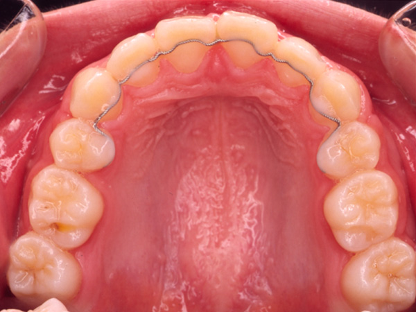 出っ歯  上顎の様子 After