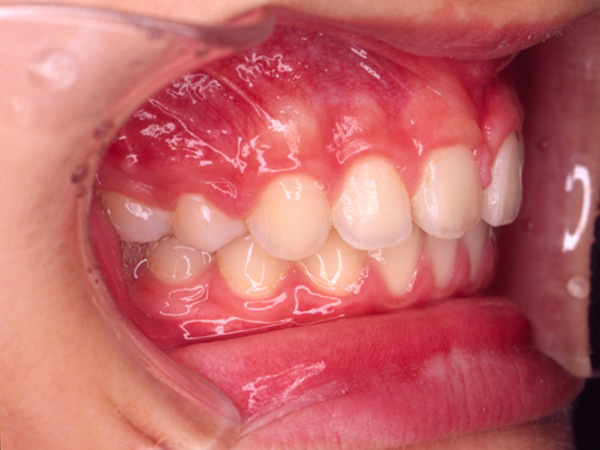 出っ歯  右側面の様子 After