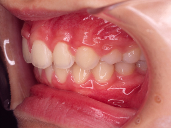 出っ歯 左側面の様子 After