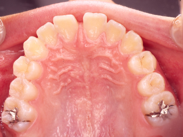 受け口と隙間が気になる 上顎の様子 Before