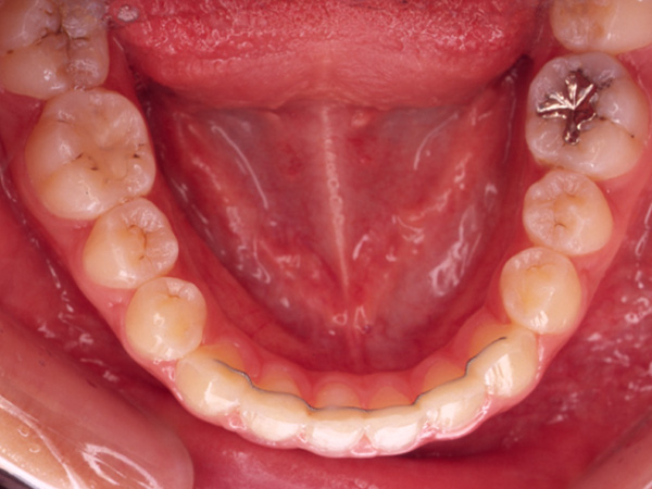 受け口と隙間が気になる 下顎の様子 After