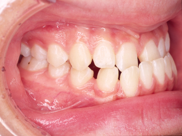 受け口と隙間が気になる 右側面の様子 Before