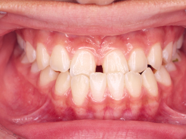 受け口と隙間が気になる 正面の様子 Before