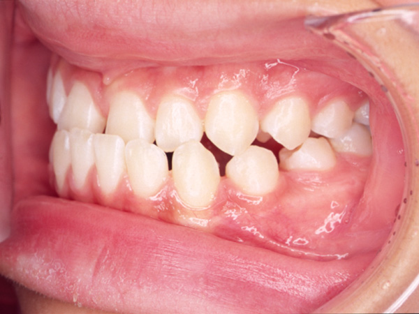 受け口と隙間が気になる 左側面の様子 Before