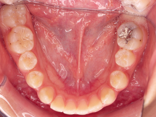 受け口と隙間が気になる 下顎の様子 Before