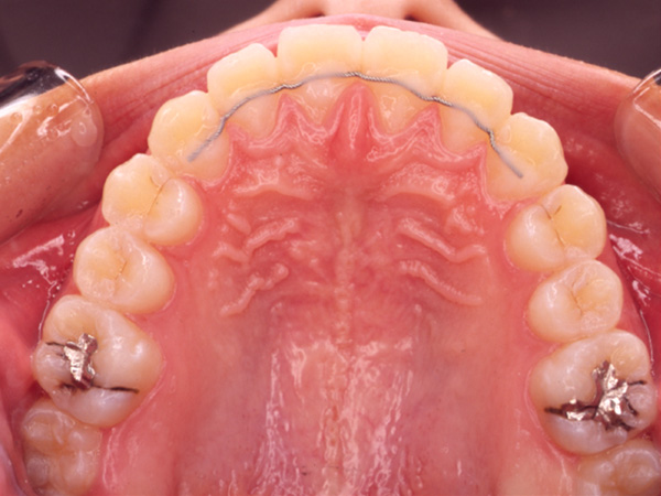 受け口と隙間が気になる  上顎の様子 After