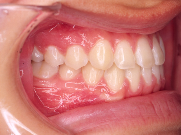 受け口と隙間が気になる  右側面の様子 After