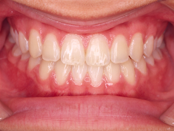 受け口と隙間が気になる  正面の様子 After