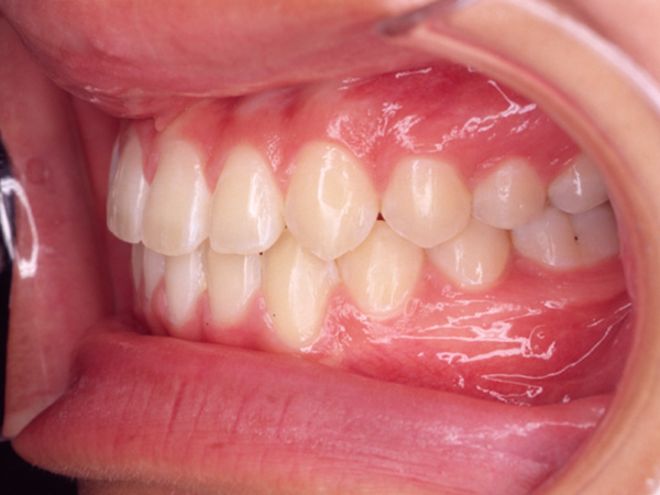 受け口と隙間が気になる 左側面の様子 After