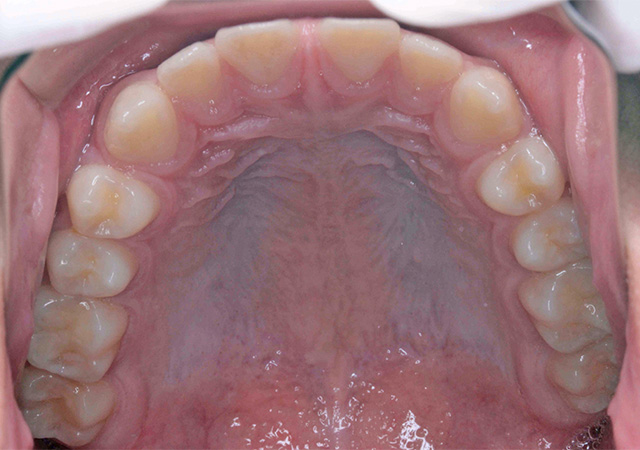 受け口と隙間が気になる 上顎の様子 Before
