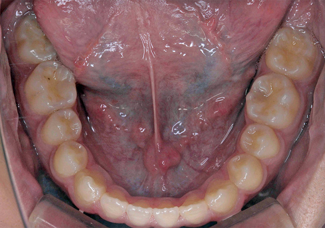 受け口と隙間が気になる 下顎の様子 After