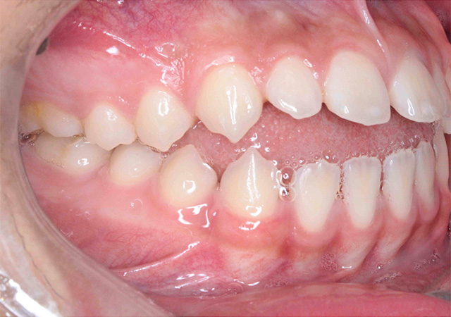 受け口と隙間が気になる 右側面の様子 Before