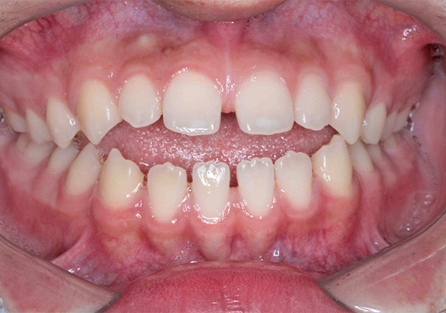 受け口と隙間が気になる 正面の様子 Before