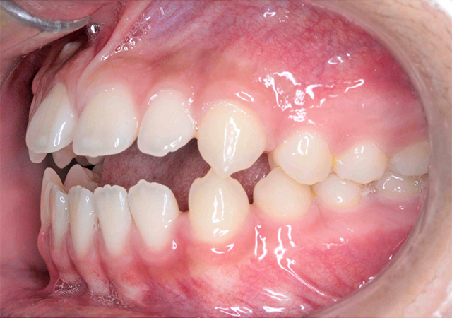 受け口と隙間が気になる 左側面の様子 Before