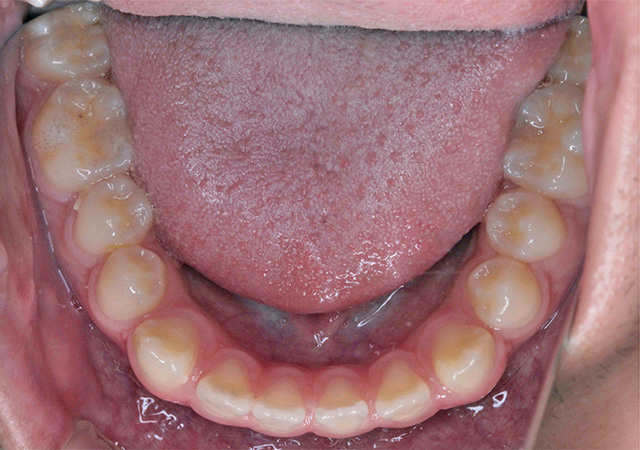 受け口と隙間が気になる 下顎の様子 Before