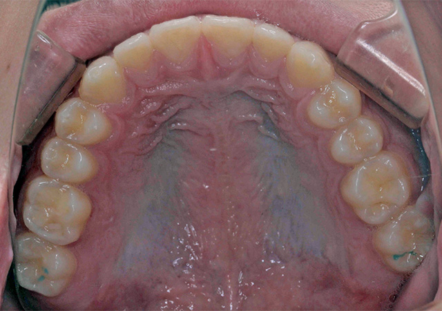 受け口と隙間が気になる 上顎の様子 After