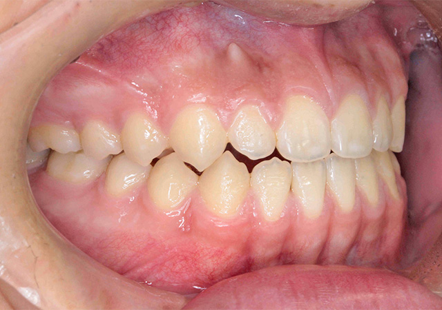 受け口と隙間が気になる 右側面の様子 After