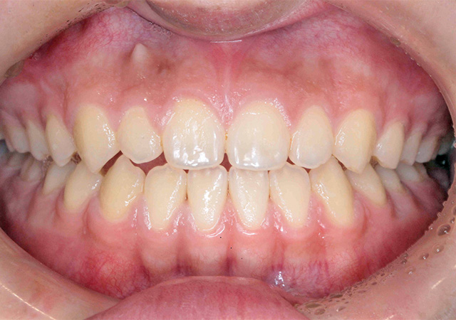 受け口と隙間が気になる 正面の様子 After