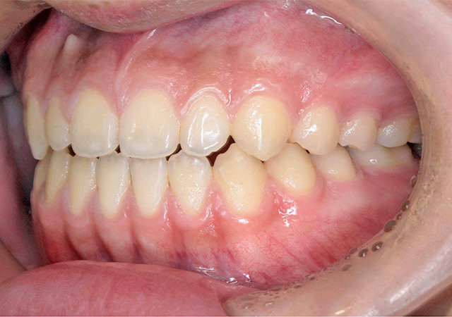 受け口と隙間が気になる 左側面の様子 After