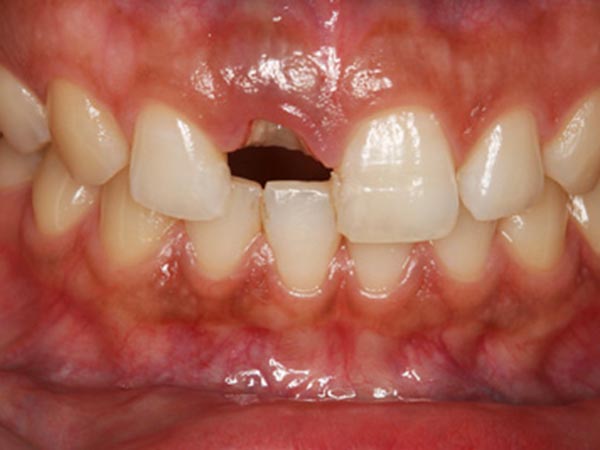 前歯のインプラント治療2 Before