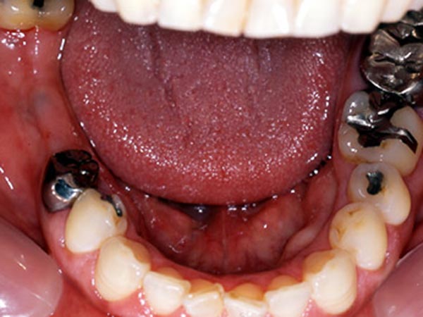 奥歯（臼歯）のインプラント治療 Before
