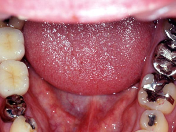 奥歯（臼歯）のインプラント治療 After