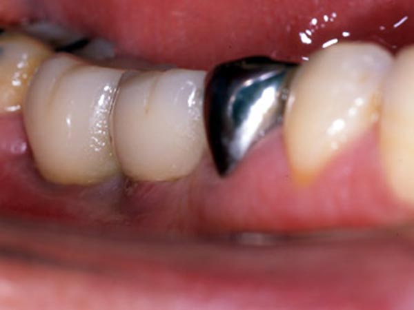 奥歯（臼歯）のインプラント治療　横から見た症例 After